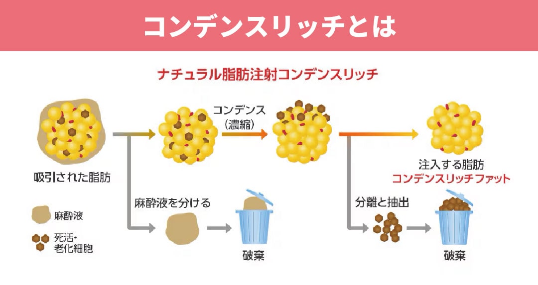 《ナチュラル脂肪注射コンデンスリッチとは》