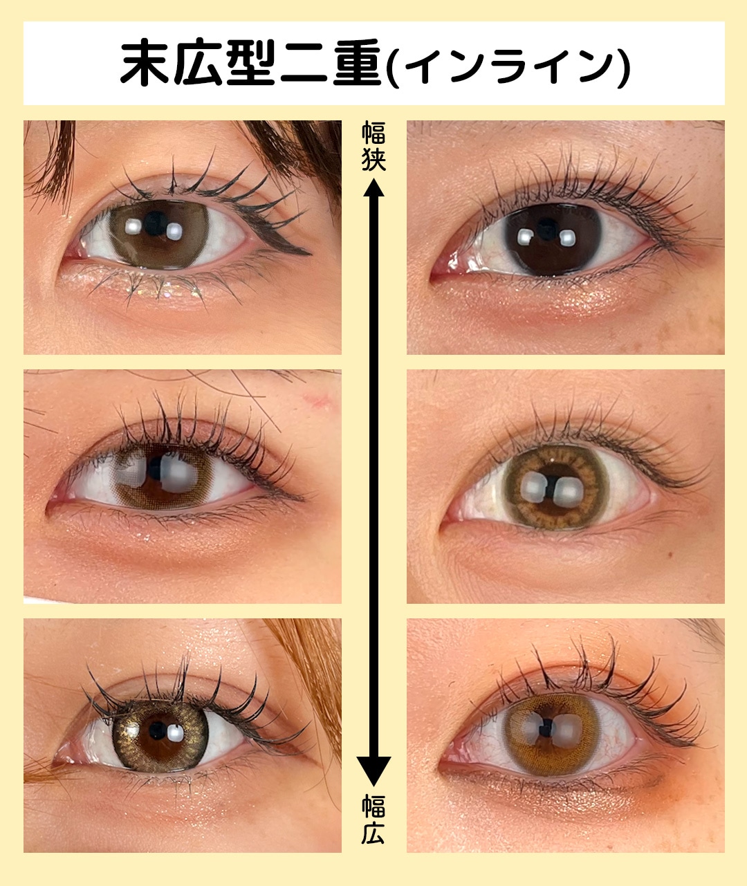 末広型二重(インライン)の幅の広がり方