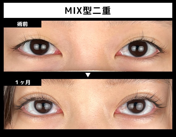 MIX型二重のBefore・After