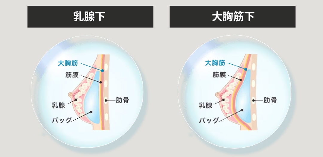 シリコンバッグを挿入する位置は？