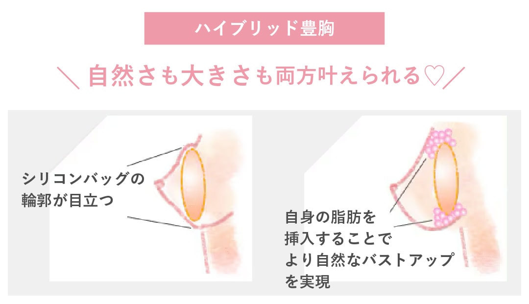 ハイブリッド豊胸