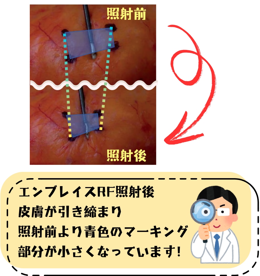 約30～40%の皮膚の収縮効果！