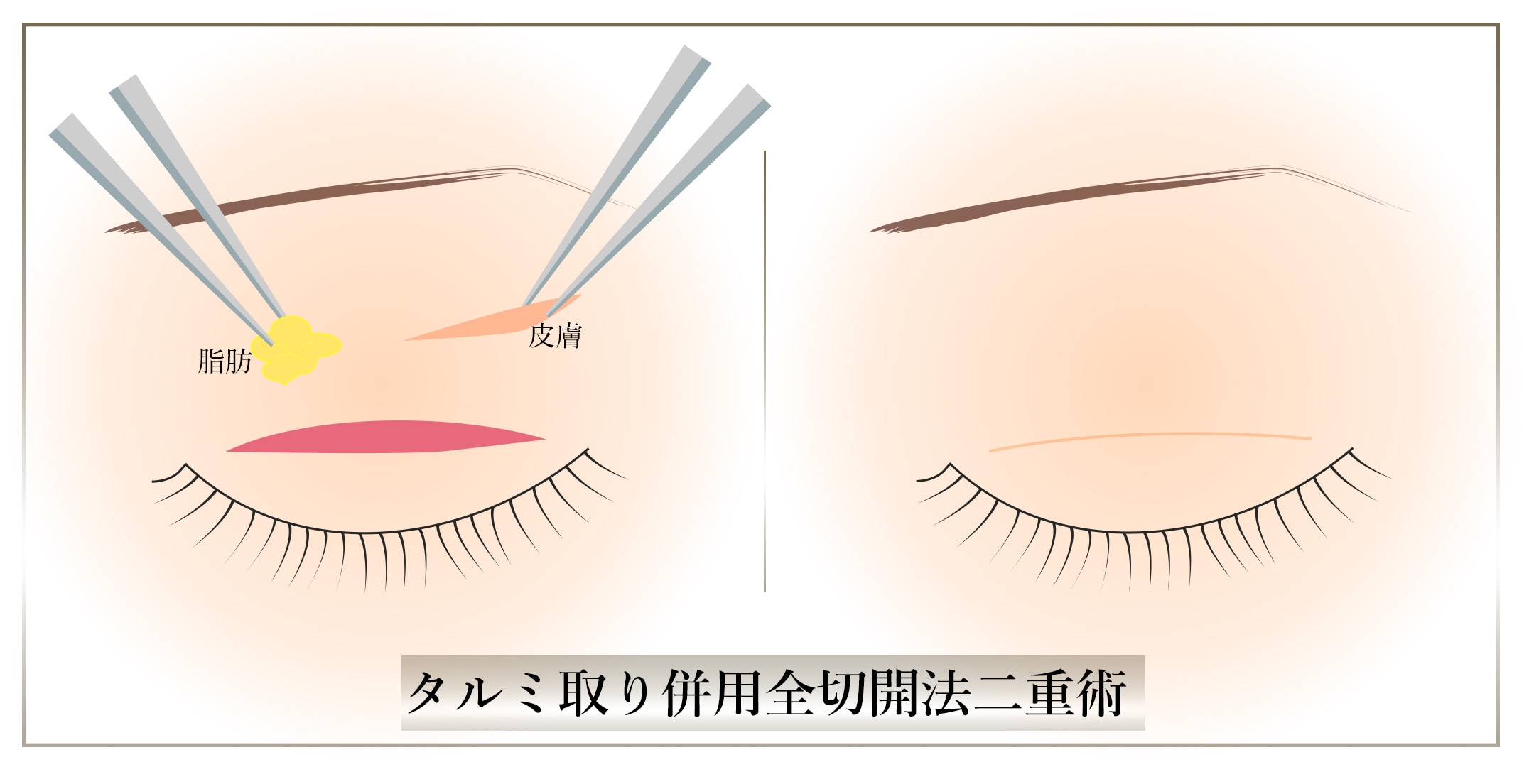 タルミ取り併用全切開法二重術とは