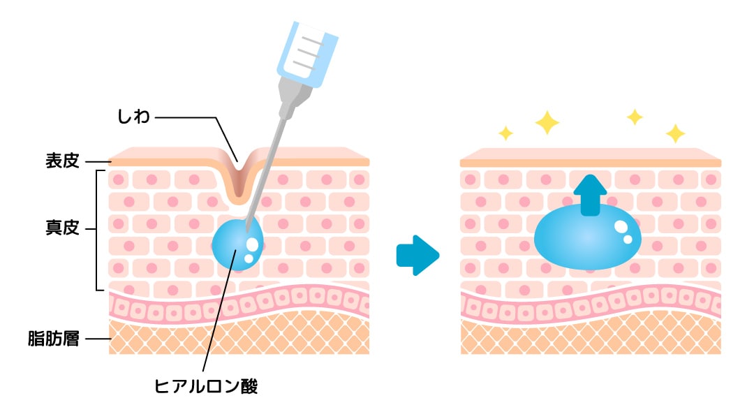 ヒアルロン酸注射って？