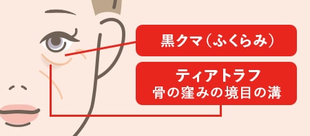 裏ハムラ法が適応になるタイプ