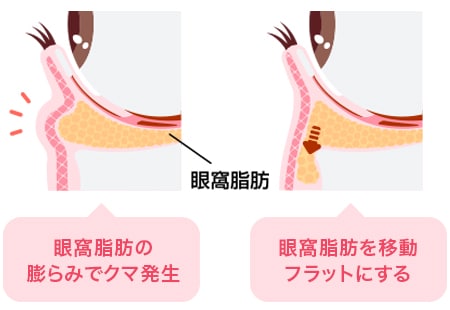 裏ハムラ法とは