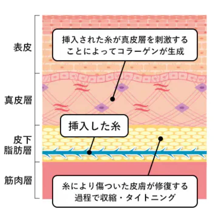 糸リフトの効果２