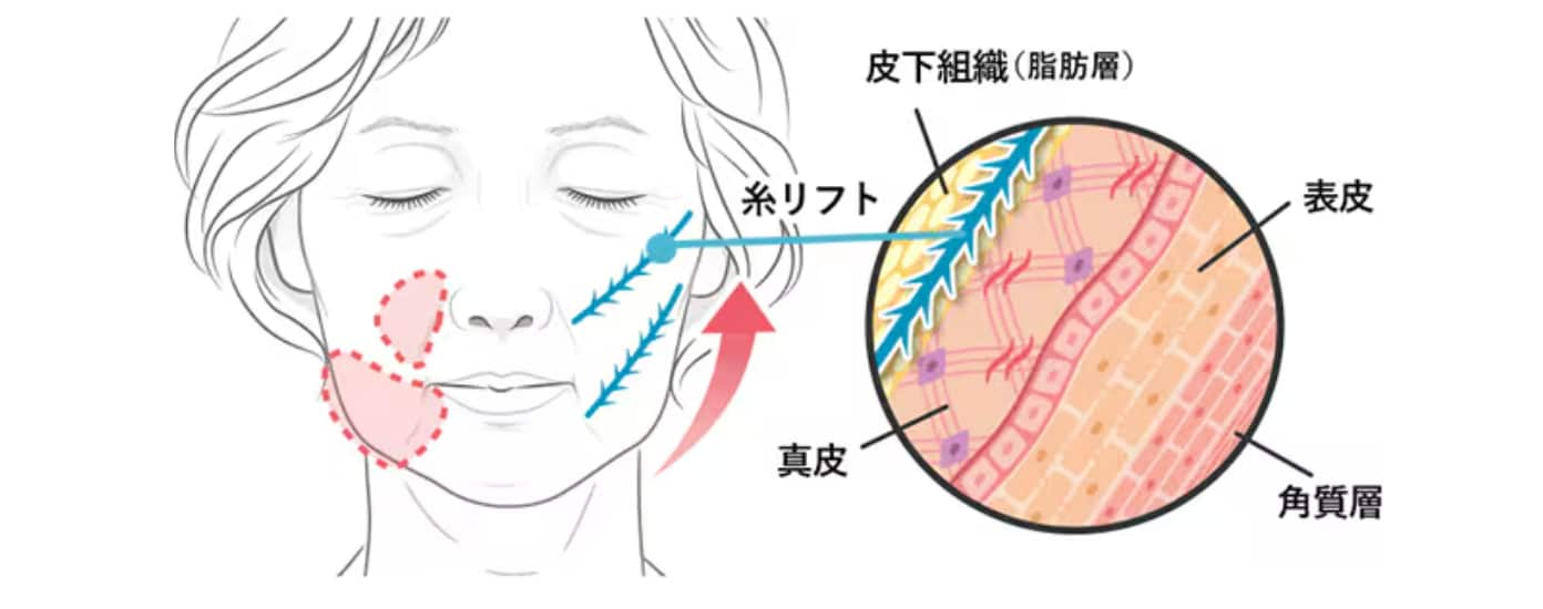 糸リフトの効果１