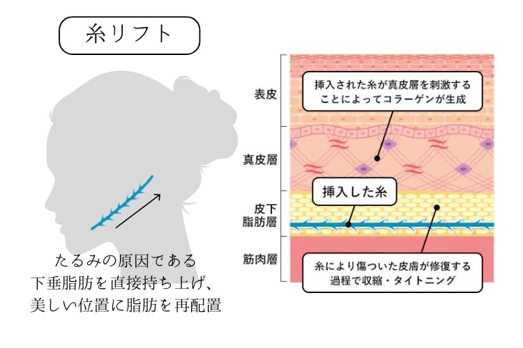 糸リフト