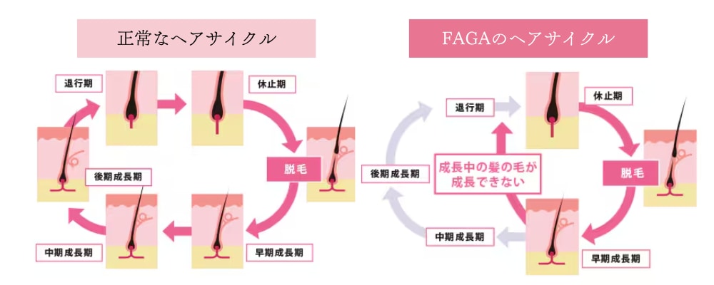 薄毛とヘアサイクル