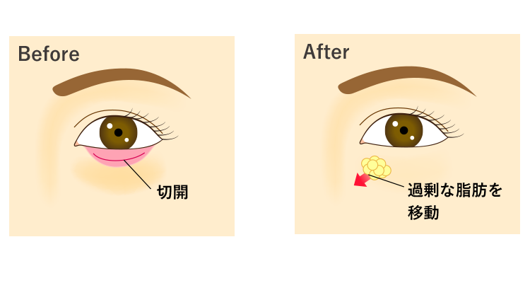 オールインワン施術とも呼ばれる裏ハムラ法とは<br />
