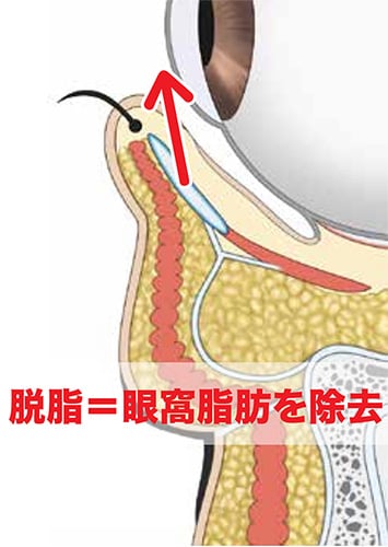 脱脂注入法とは