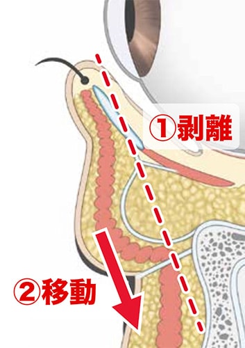 裏ハムラ法では治せない？