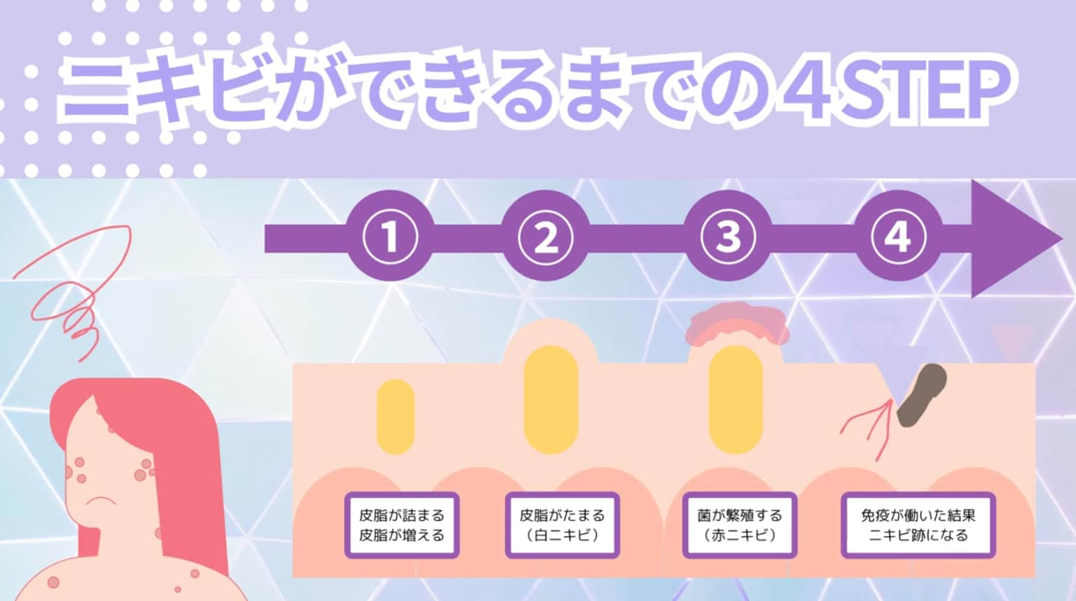 ニキビができるまでの４STEP