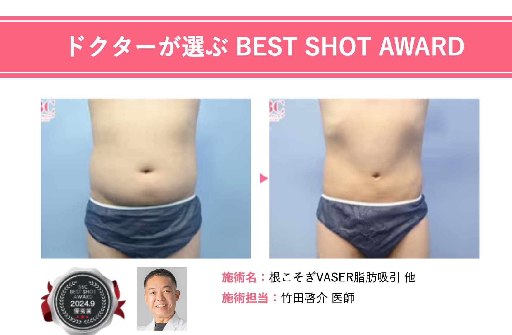 竹田医師の【男性 お腹の脂肪吸引 】