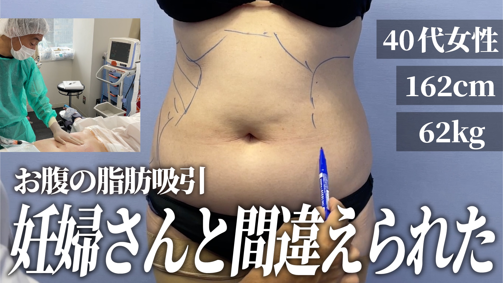 【症例あり】41歳女性、「妊娠したの？」と言われたお腹から脂肪吸引でくびれをGET【東京で脂肪吸引なら湘南美容クリニック新橋銀座口院・根こそぎ竹田先生】