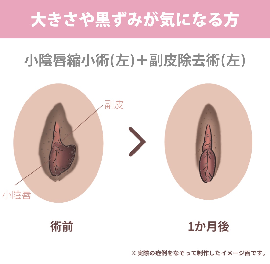 大きさや左右差を改善できる「小陰唇縮小術」