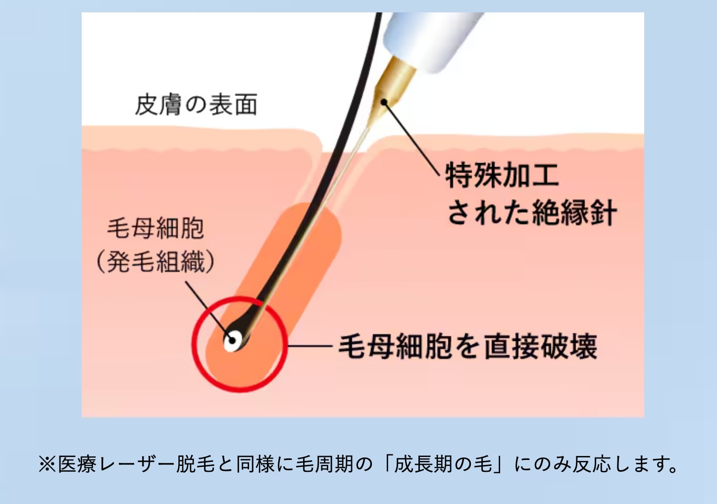 今SNSでも話題の【針脱毛】とは？