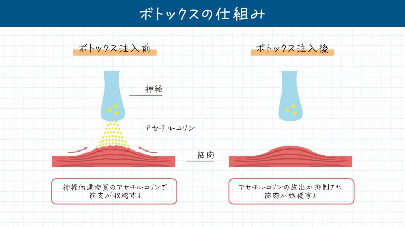 アセチルコリン＝シワの原因