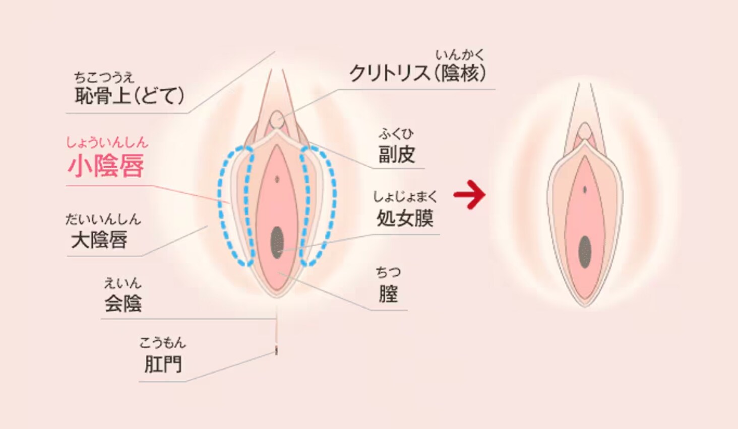 小陰唇縮小術とは？