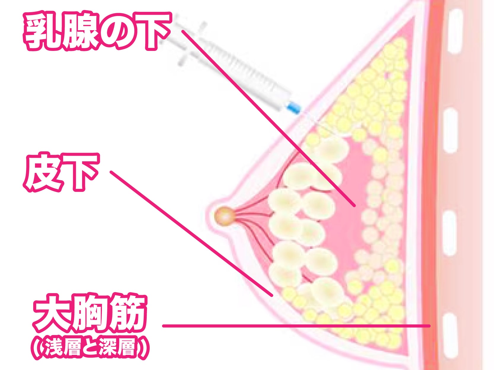 【4】しこりのリスクを極限まで下げ、高い定着率を誇る「脂肪注入へのこだわり」