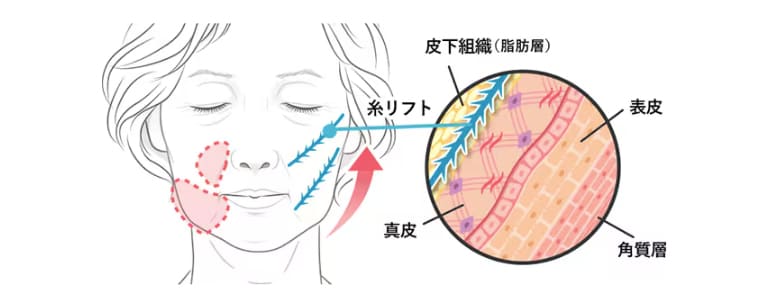 下垂脂肪を直接持ち上げ、美しい位置に脂肪を再配置