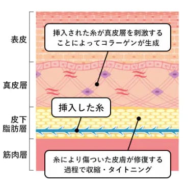 今の引き上げだけじゃない！<br />
糸リフトなら、未来のたるみも作らない。