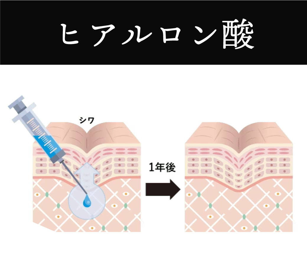 ヒアルロン酸注入の場合