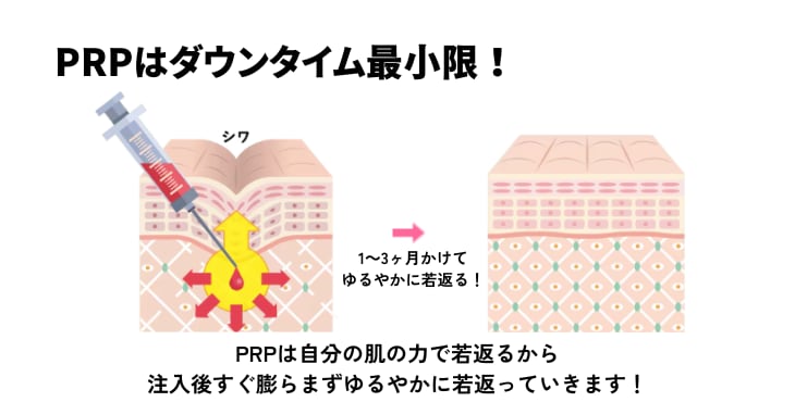 PRPはなぜ腫れづらいの？脂肪注入と違い