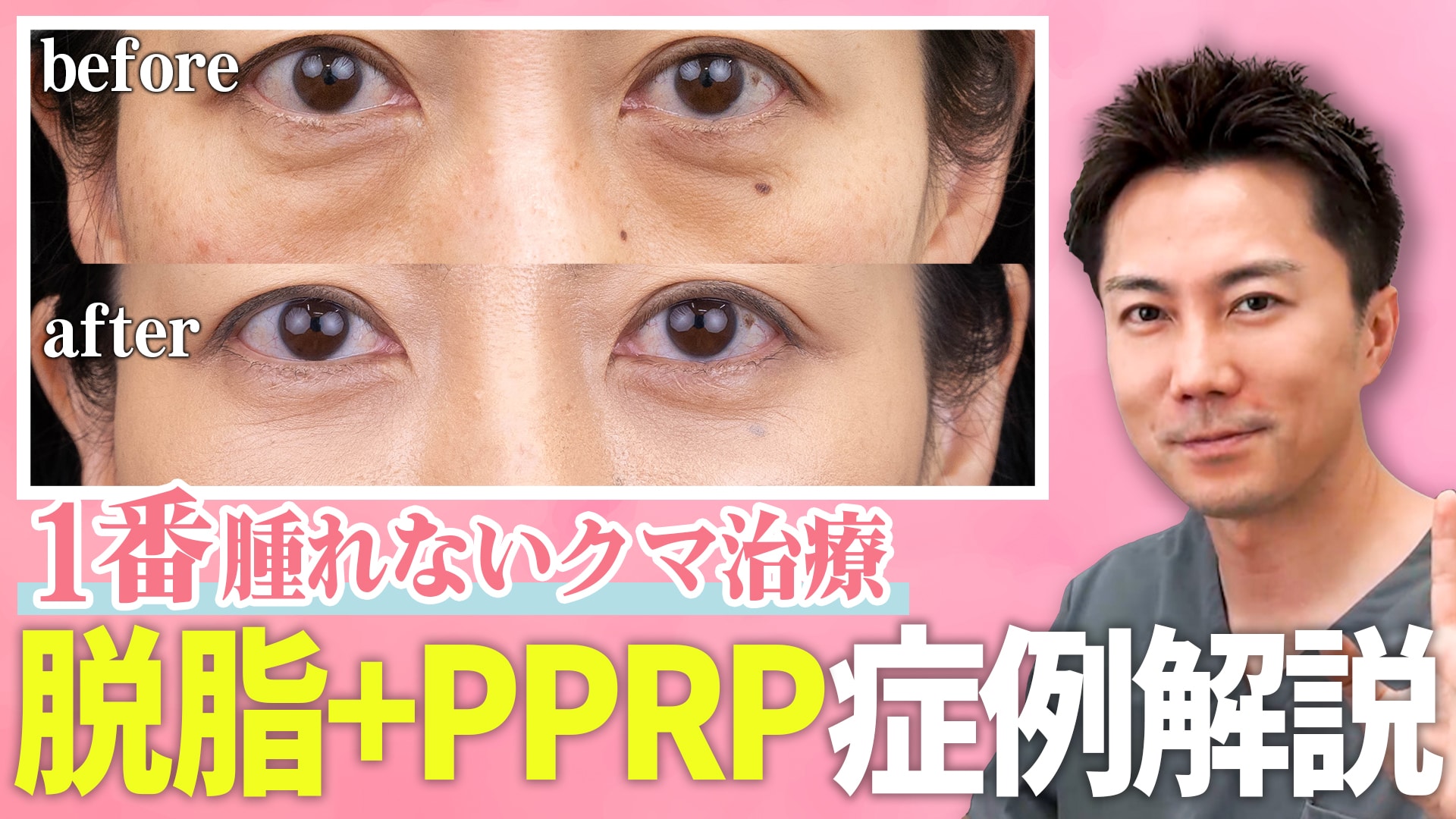 【一番腫れないクマ取り？！】ダウンタイムを最小限にするなら「脱脂+PRP」のクマ取りがオススメ！