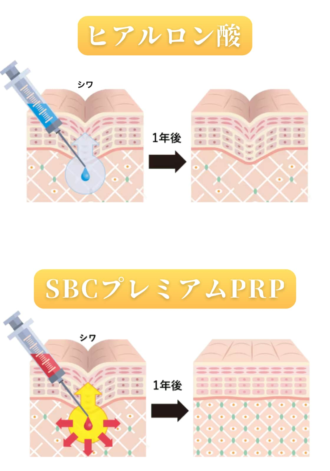 PRPは継続力の高い根本的な若返り治療！