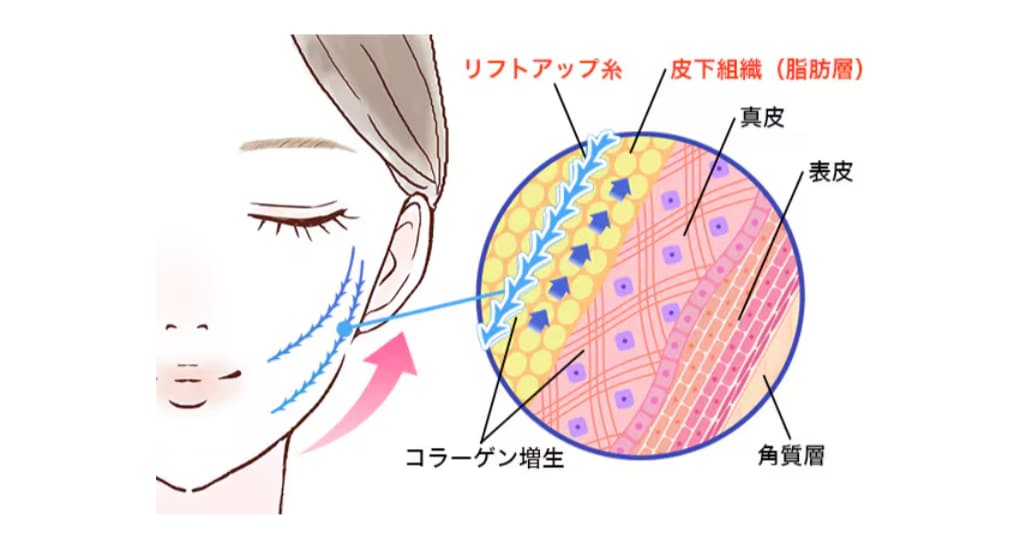 糸リフトとはこんな施術