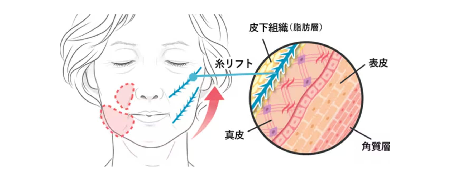 そもそも糸リフトってどんな施術？