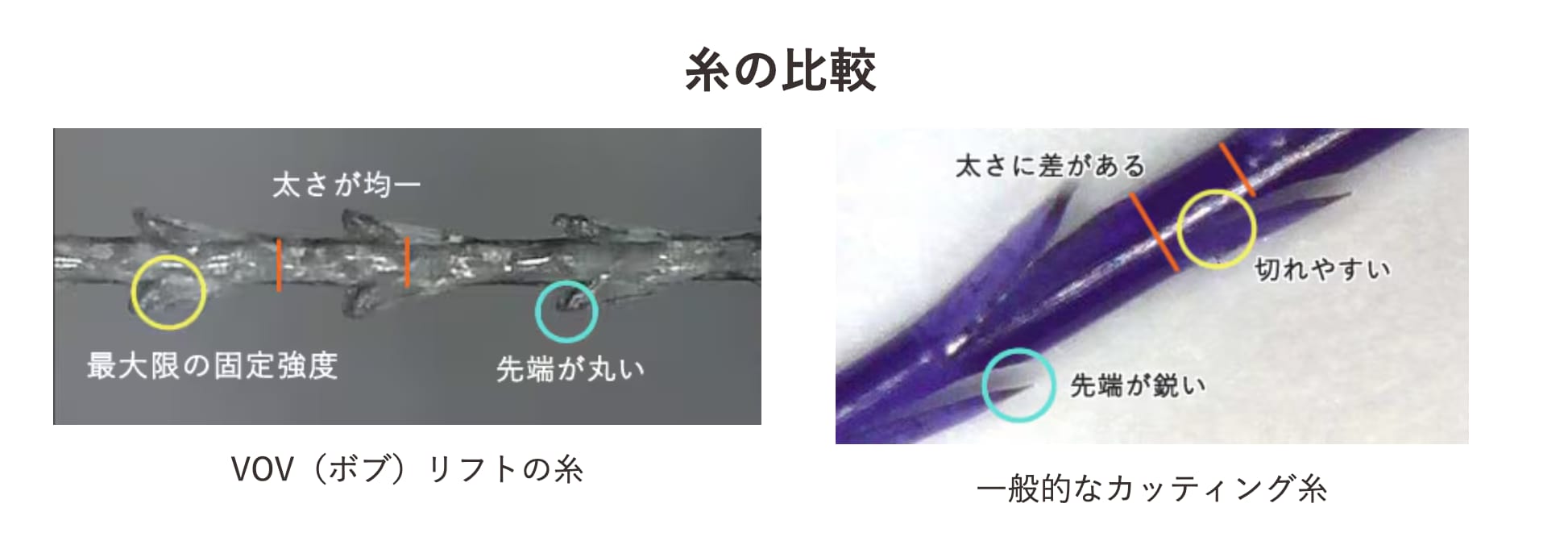 ほうれい線・顎下のたるみが気になるなら！VOVリフト