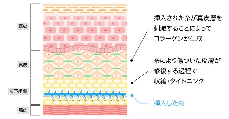 入れた糸はどうなるのでしょうか