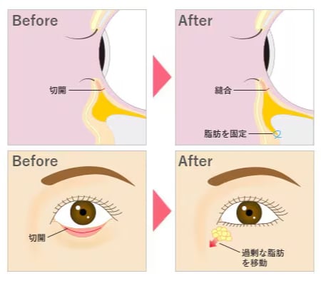 裏ハムラ法とは？