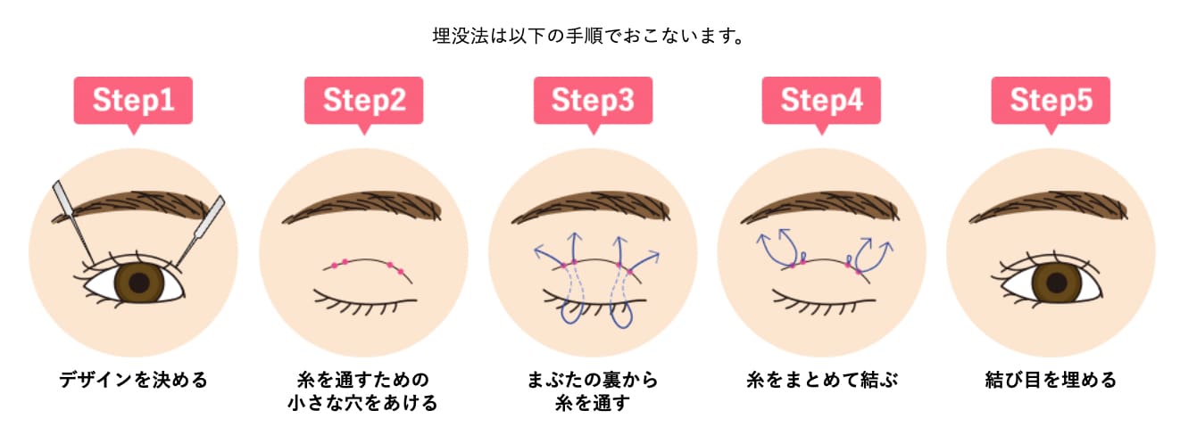 そもそも埋没二重の仕組みは？