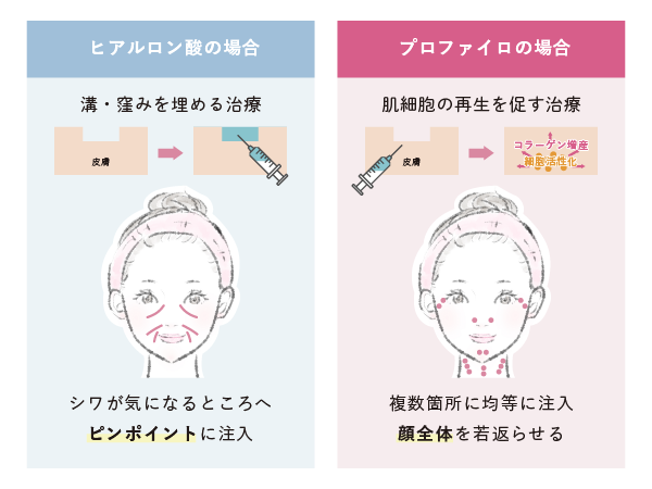 プロファイロとは？