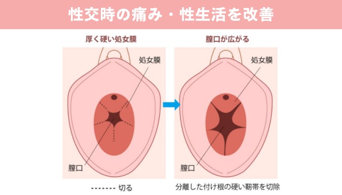 処女膜切開術