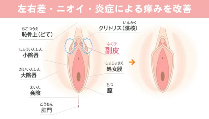 副皮除去術