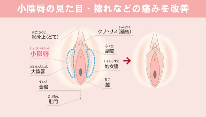 小陰唇縮小術