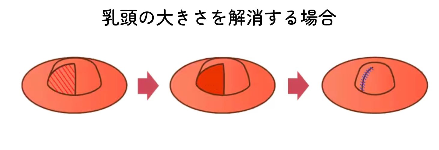 乳頭の大きさの縮小