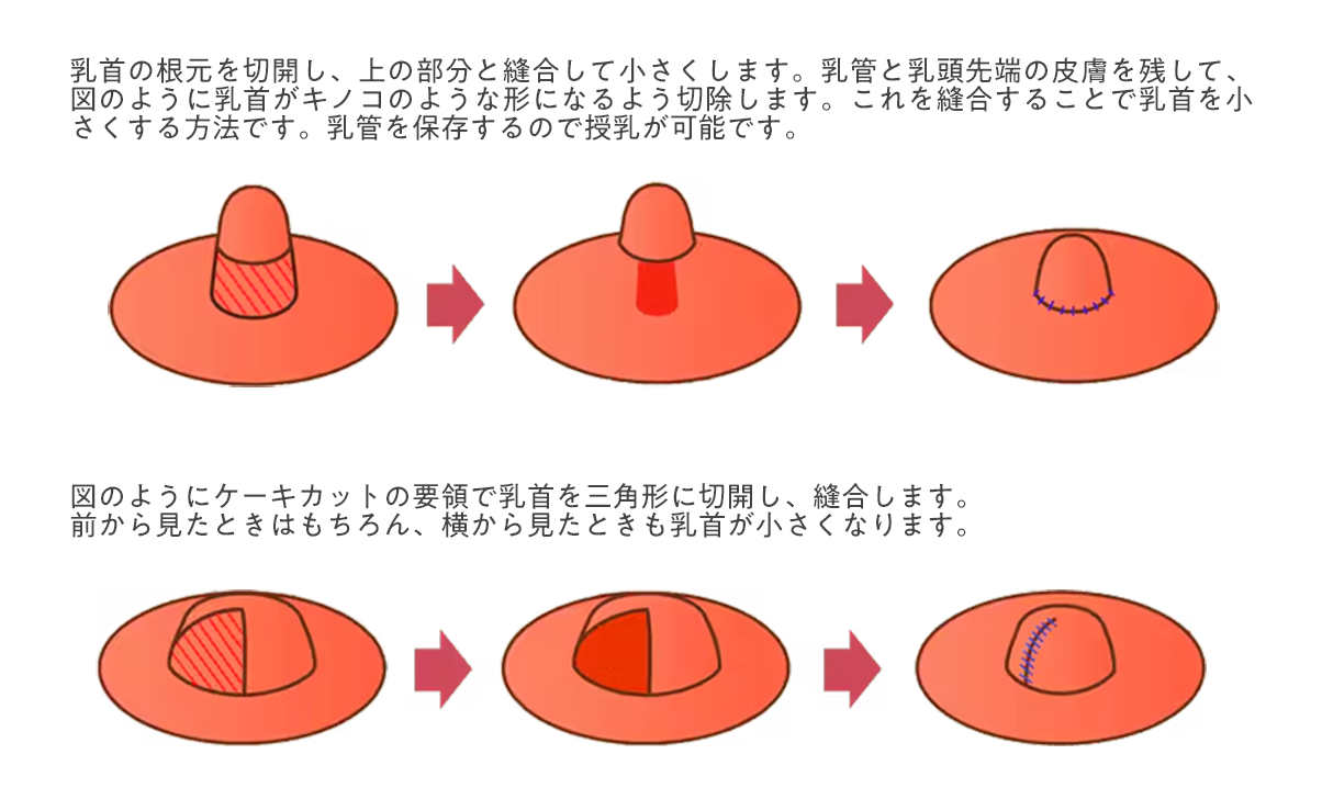 乳頭縮小