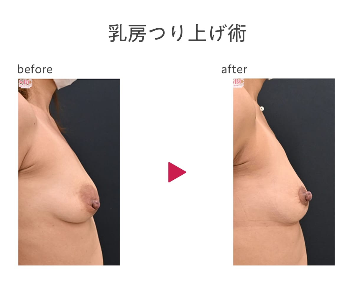 乳房つり上げ術