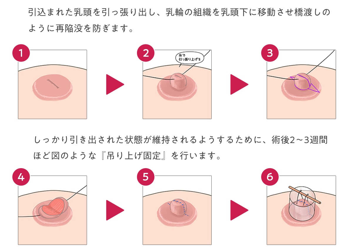 陥没乳頭