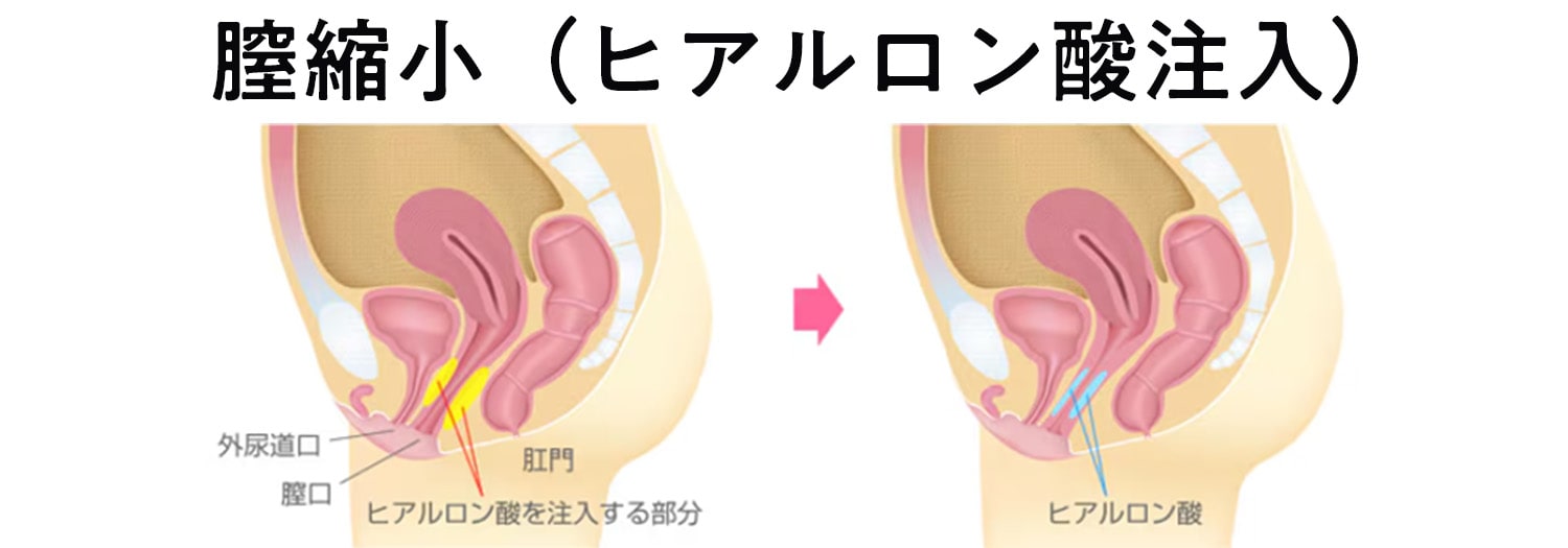 プチ膣縮小（ヒアルロン酸）