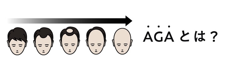 男性の脱毛症を指します