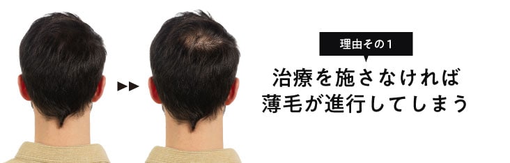 理由①治療を施さなければ薄毛が進行してしまう