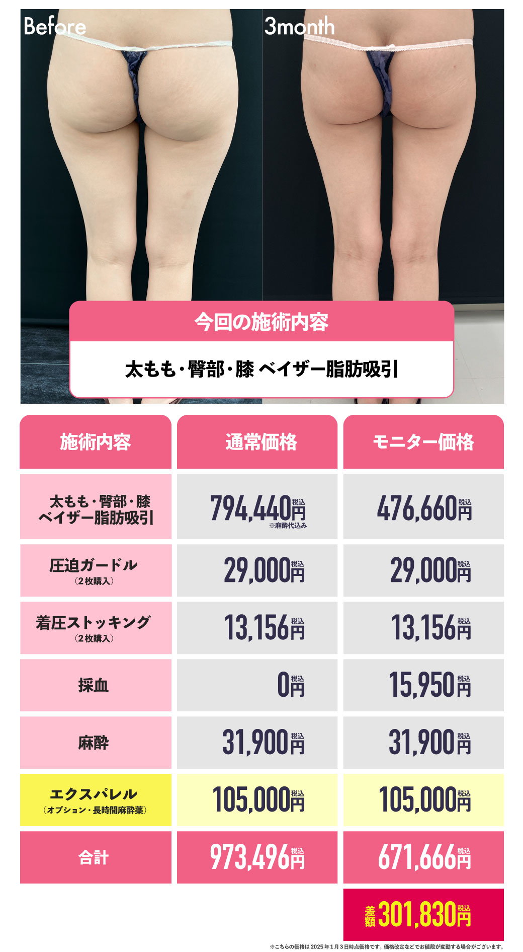 太ももの脂肪吸引の場合