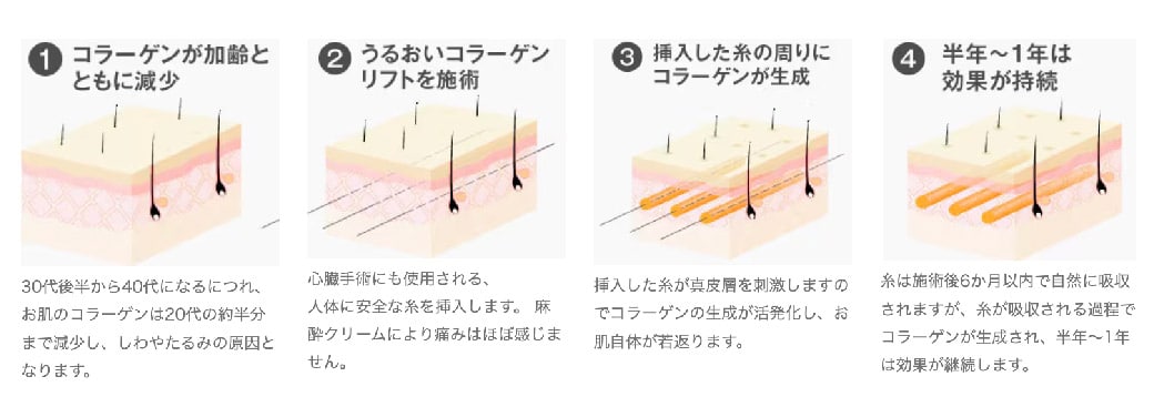 どういうメカニズム？